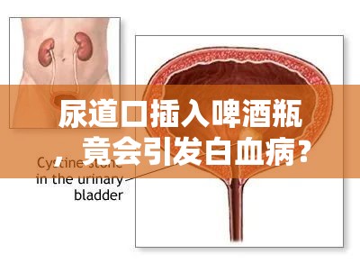 尿道口插入啤酒瓶，竟会引发白血病？背后的秘密让人不寒而栗！